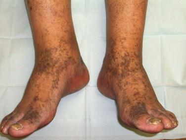 FIGURE 7-5, Minocycline-induced hyperpigmentation, Type II. The patient has gray-brown pigmentation on the dorsal feet.