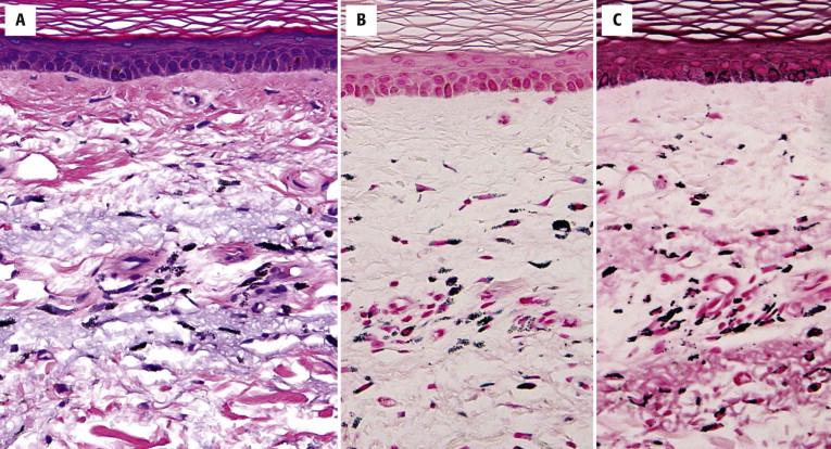 FIGURE 7-6, Histology of minocycline-induced hyperpigmentation. A, Granular, dark-brown or black pigment is present, both free within the dermis and within dermal dendrocytes. The pigment granules are highlighted by both the Prussian-blue reaction ( B ) and Fontana-Masson ( C ).