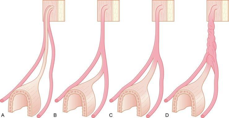 Fig. 5.1, The four common variants of urachal anatomy.