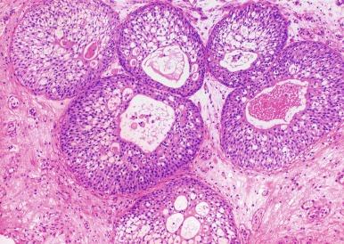 Fig. 5.13, Cystitis glandularis of the typical/conventional type.