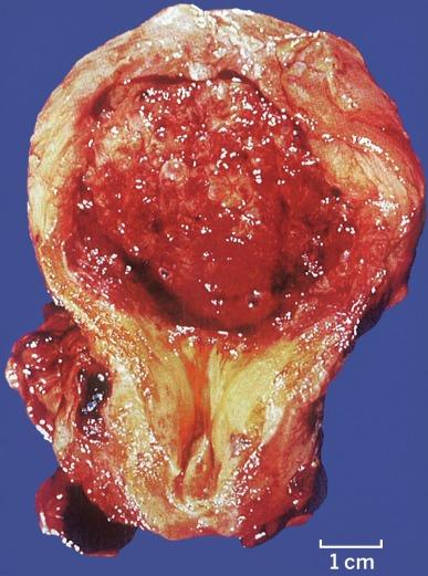 Fig. 5.14, Cystitis cystica appears as thin-walled domed mucosal cysts or blebs.