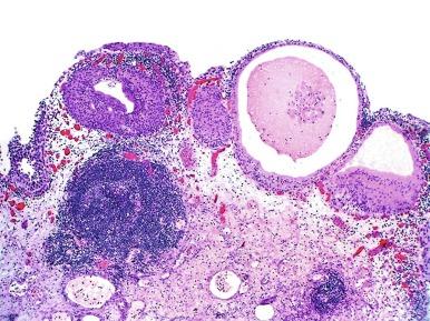 Fig. 5.16, Cystitis glandularis and cystitis cystica may frequently be seen together and are part of the so-called proliferative cystitis in urologic literature.