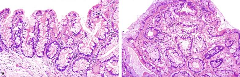 Fig. 5.17, (A) Cystitis glandularis, intestinal type. There are spaced tubular glands lined by goblet cells. The surface epithelium is also mucinous. (B) Cystitis glandularis, intestinal type. The glands closely resemble colonic glands.