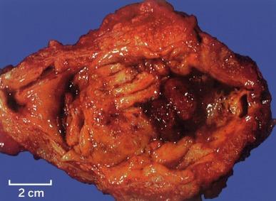 Fig. 5.18, Extensive cystitis glandularis, intestinal type (intestinal metaplasia).
