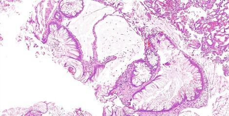 Fig. 5.20, Occasionally intestinal metaplasia may be associated with extensive mucin extravasation.