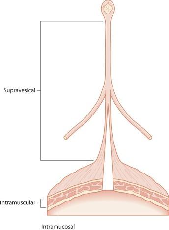 Fig. 5.2, The urachus is composed of intramucosal, intramuscular, and supravesical segments.