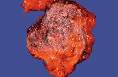 Fig. 5.21, Keratinizing squamous metaplasia is gray with flecks of light-colored keratin.