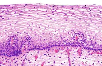 Fig. 5.22, Squamous metaplasia replacing the urothelium.