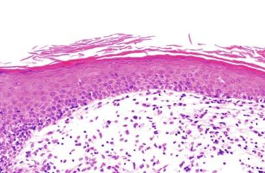 Fig. 5.23, Keratinizing squamous metaplasia with parakeratosis.