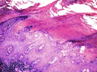 Fig. 5.25, Verrucous squamous hyperplasia is considered a premalignant lesion of squamous cell carcinoma when present in the bladder. This case was found adjacent to a verrucous squamous cell carcinoma.