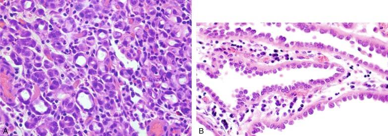 Fig. 5.26, (A) Tubules of nephrogenic adenoma lined by cuboidal epithelium resembling renal medullary tubules. (B) Tubules of nephrogenic adenoma lined by hobnail cells.