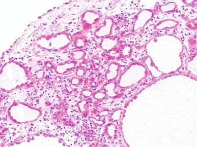 Fig. 5.27, Cystic dilation of tubules in nephrogenic adenoma.