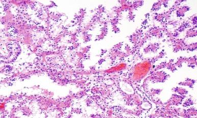 Fig. 5.28, Papillary nephrogenic adenoma.