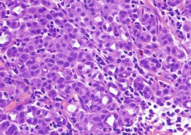 Fig. 5.29, Diffuse or solid pattern of nephrogenic adenoma.