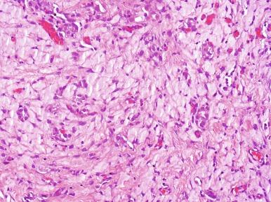 Fig. 5.30, Fibromyxoid nephrogenic adenoma with small tubules embedded in a myxoid background stroma.