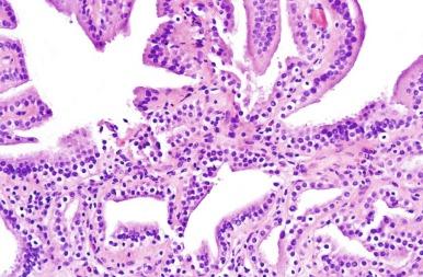 Fig. 5.33, Nephrogenic adenoma with predominance of the papillary component.