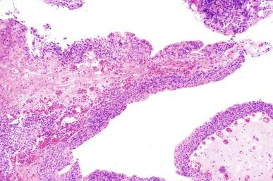 Fig. 5.36, Papillary cystitis with finger-like fronds covered by a few layers of urothelium.