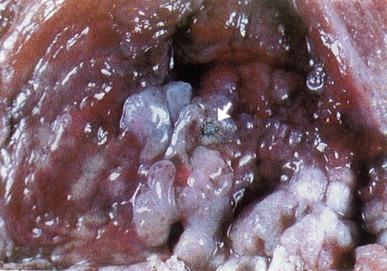 Fig. 5.38, Polypoid cystitis.