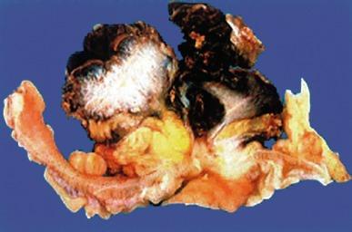 Fig. 5.40, Colovesical fistula secondary to adenocarcinoma of colon.
