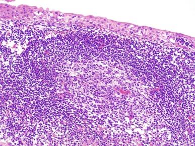 Fig. 5.42, Follicular cystitis.