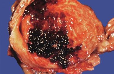 Fig. 5.44, Hemorrhagic cystitis.