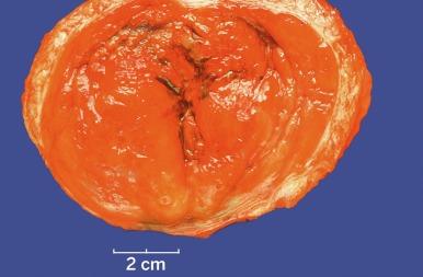 Fig. 5.46, Chronic interstitial cystitis.