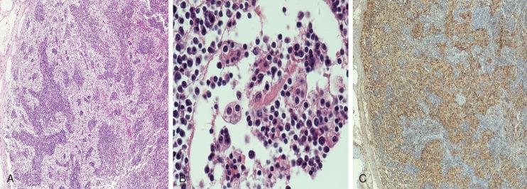 Figure 52-1, Sinus histiocytosis with massive lymphadenopathy.