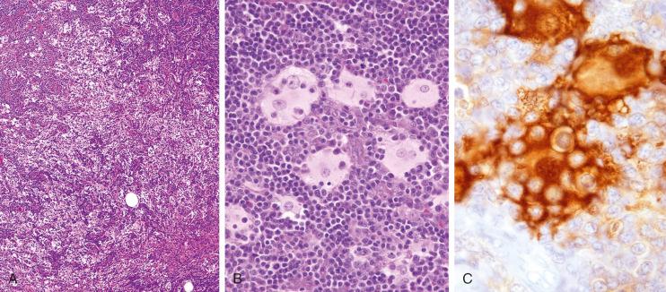 Figure 52-2, Sinus histiocytosis with massive lymphadenopathy.