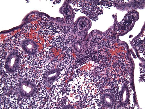 FIG. 9.1, Early proliferative endometrium composed of round to tubular glands with subtle proliferative features, admixed with stromal breakdown (upper aspect) .