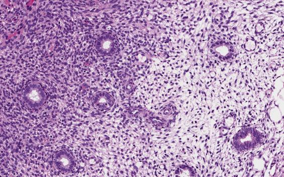 FIG. 9.11, Oral contraceptives, early changes. Glands are uniform and round with subnuclear vacuolization and no mitoses; stroma is variably edematous.