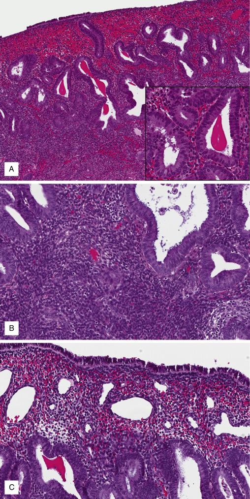 FIG. 9.12, Progesterone receptor modulator-associated changes. Gland tortuosity (A) and variation in size and incipient secretory changes (inset) . Stroma is densely cellular and lacks secretory-phase changes (B). Capillary ectasia can be observed (C).