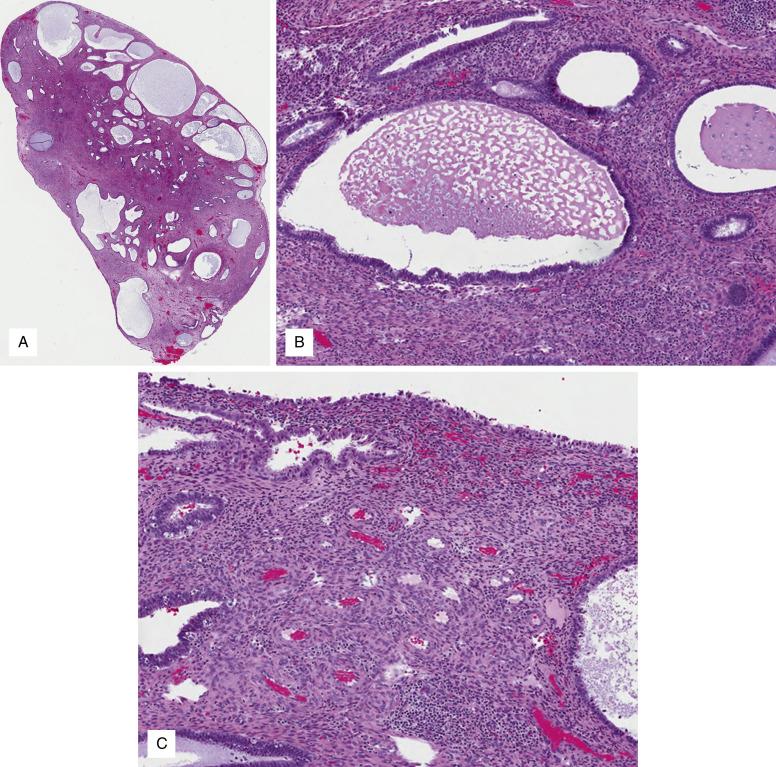 FIG. 9.13, Endometrial polyp excised intact. Cross section shows an exophytic/pedunculated lesion composed of markedly irregular and dilated glands and fibrotic stroma (A). Glands are variably sized, many cystically dilated; stroma is fibrotic and less cellular compared to the endometrium functionalis (B). Thick-walled vessels close to the surface are characteristic (C).