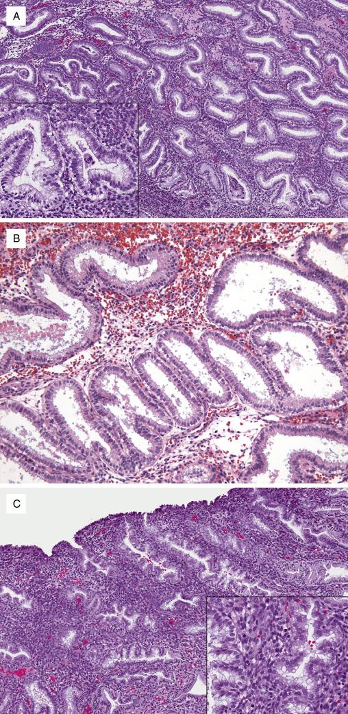 FIG. 9.4, Early secretory phase endometrium. Day 17 (A), epithelial vacuolization becomes uniform and diffuse (inset) . It is predominantly subnuclear. Day 18 (B), progressive migration of the vacuoles to a supranuclear location. Day 19 (C), predominant supranuclear vacuolization (inset) . Stroma is dense and uniform.