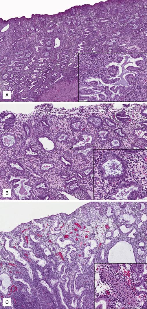 FIG. 9.5, Mid secretory phase endometrium. Day 20 (A), peak of intraluminal secretions (inset) . Day 21 (B), stroma becomes progressive edematous. Day 22 (C), stroma displays diffuse edema; with extracellular fluid accumulation, stromal cells separate and appear as “cuffs” around spiral arterioles (inset) —lack of predecidual change distinguishes this day from the late secretory phase.