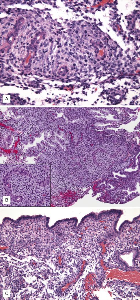 FIG. 9.6, Late secretory phase endometrium. Day 23 (A), predecidualization starts in stroma around spiral arterioles. Day 24 (B), predecidualization extends to stroma bridging vessels and glands of the functionalis. Notice the visible polygonal cytoplasm in predecidual stromal cells ( inset , compare to stromal cuffs of day 22). Day 25 (C), a thin layer of predecidua forms in the surface. Day 26 (D), surface layer of predecidua thickens. Day 27 (E), predecidual change involves the entire functionalis. Scant neutrophils start to infiltrate the predecidua (arrowheads in inset) .