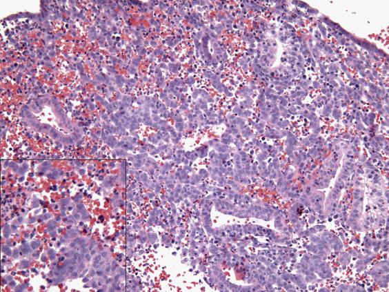 FIG. 9.7, Menstrual endometrium. Extensive stromal breakdown in the form of predecidual stromal aggregates with abundant neutrophils and collapsed, exhausted secretory glands.