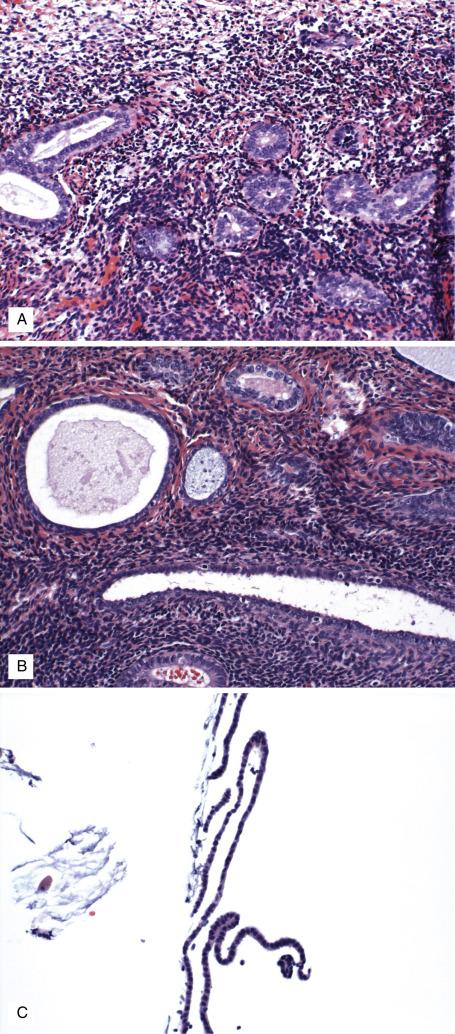 FIG. 9.9, Inactive endometrium. Uniformly spaced glands composed of bland cuboidal epithelium in a densely cellular stroma (A). Postmenopausal endometrium commonly shows cystic gland dilation and less cellular areas of stroma with a “fibrotic” appearance (B). In biopsy and curettage specimens from postmenopausal patients, material is often scant and superficial (strips of surface endometrium with no underlying stroma) (C).