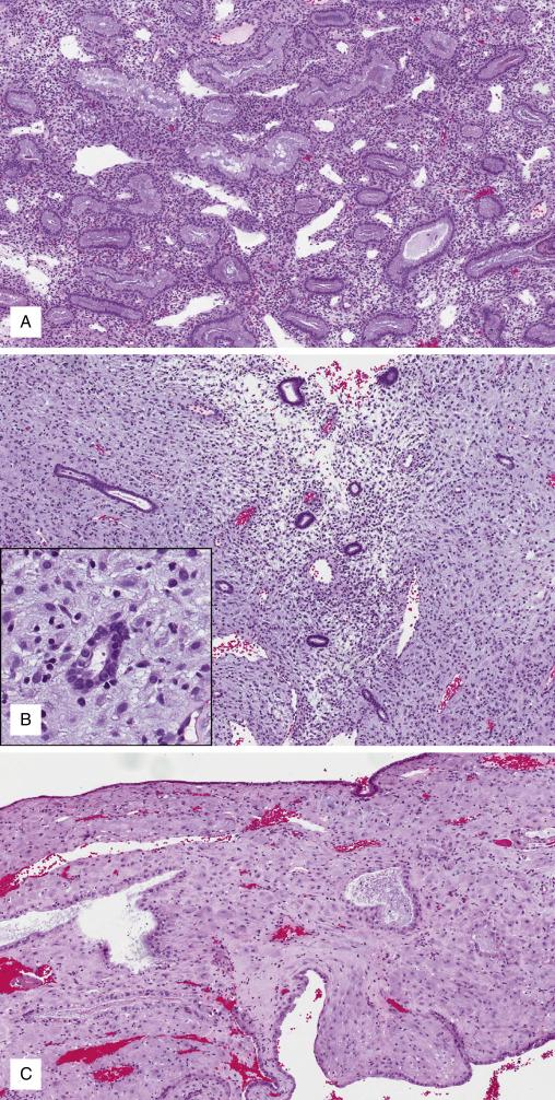 FIG. 9.10, Exogenous progestin therapy. Endometrium under the initial weeks of therapy displays glandular secretory differentiation indistinguishable from the early or midsecretory phases (A). In endometrium under prolonged (months) therapy, glands regress to an inactive state while the stroma progresses to a diffusely pseudodecidualized morphology (B). Endometrium under prolonged stimulation by a progestin-releasing intrauterine device shows prominent stromal pseudodecidual change (C).