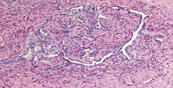 FIG. 13.1, Rete ovarii. Microscopic focus of compressed glands lined by simple epithelium, located in the ovarian hilum.