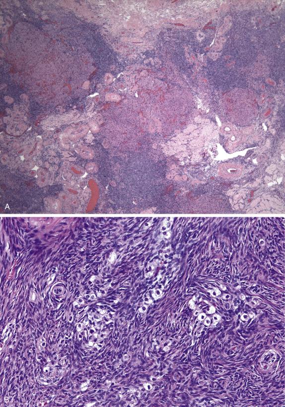 FIG. 13.12, Stromal hyperthcosis. Multiple discrete nodules (A) , nests or single luteinized cells with abundant pale vacuolated to eosinophilic cytoplasm are present within the ovarian parenchyma (B). An inhibin stain highlights the luteinized component in a background of stromal hyperplasia (C).