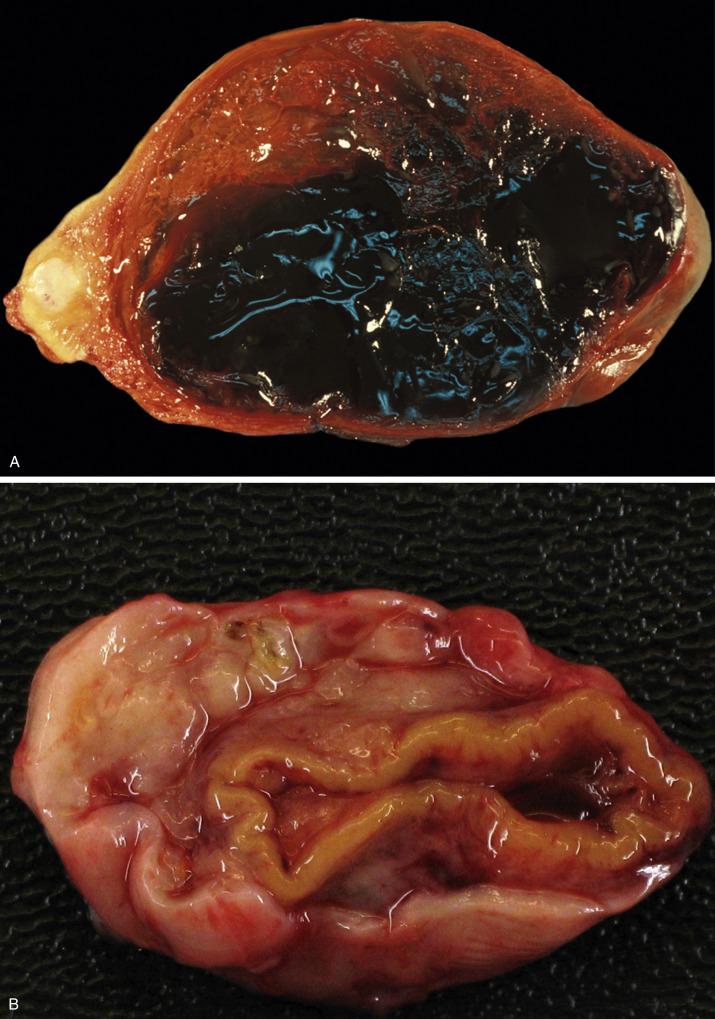 FIG. 13.3, Corpus luteum cyst. The cyst shows an orange-brown cut surface with central hemorrhage (A). An established corpus luteum cyst may show a yellow rim of variable thickness which delineates the wall (B).