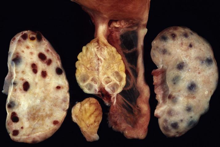 FIG. 13.4, Polycystic ovary syndrome. The ovaries are enlarged bilaterally due to multiple follicle cysts and expanded stroma. Note normal-sized ovaries in the middle for comparison.