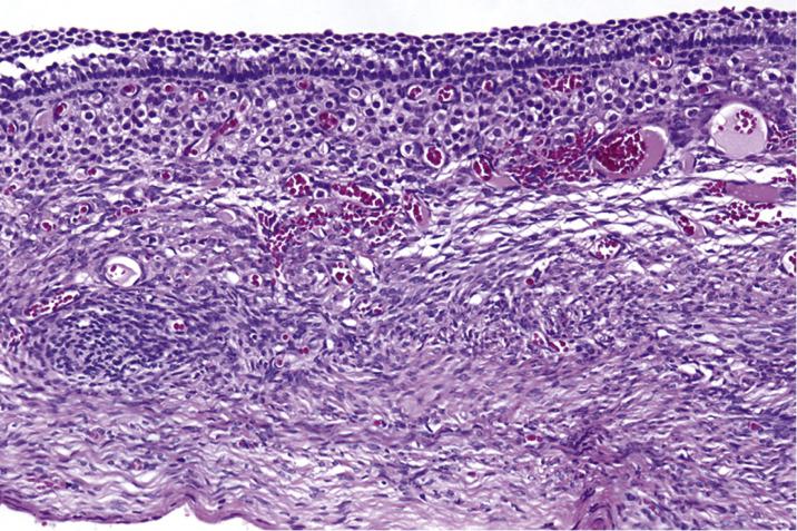 FIG. 13.5, Follicular cyst. The cyst is lined by several layers of granulosa cells and luteinized theca cells.