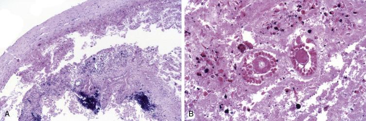 FIG. 13.6, Follicular cyst. Torsion results in secondary infarction, fibrin deposition, and calcification (A). High-power scrutiny reveals ghost structures including primary follicles (B).