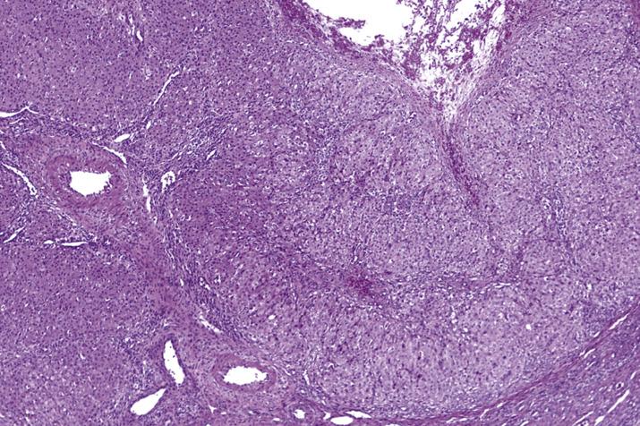 FIG. 13.7, Corpus luteum cyst. It is distinguished from a follicular cyst by its undulating contour and marked luteinization of the granulosa cells.