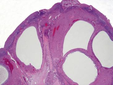 FIG. 13.8, Polycystic ovary syndrome. The follicular cysts have round rigid outlines and are mainly distributed beneath the ovarian surface.