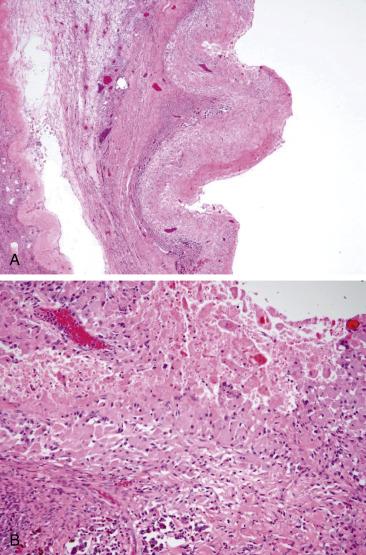 FIG. 13.9, Endometriotic cyst. At low power, the undulating outline associated with foamy histiocytes with abundant eosinophilic cytoplasm may mimic the appearance of a corpus luteum cyst (A, B).