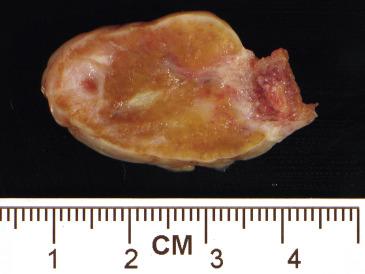 FIG. 13.10, Stromal hyperthecosis. The ovarian cortex and medulla are expanded and have a yellow to brown cut surface.