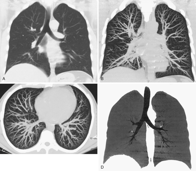 FIG 36-1, Normal CT anatomy of the tracheobronchial tree. A, Coronal MPR volume-rendered image through the carina shows a normal tracheobronchial tree. Coronal ( B ) and axial ( C ) MIP images show a normal pulmonary vasculature. MIP enhances visualization of the pulmonary vessels. D, Coronal MPR minimum intensity projection (MiniP) image shows a normal tracheobronchial tree. Images were reconstructed using 5 contiguous 1-mm sections obtained from a 16-detector CT scanner using 1-mm collimators.