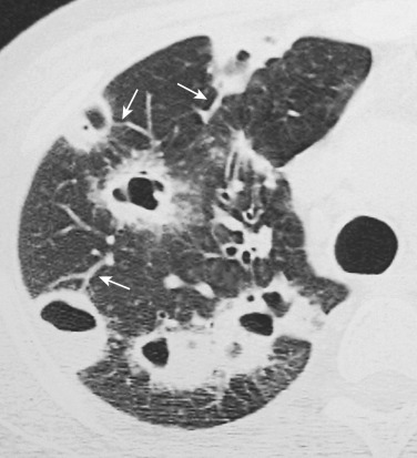 FIG 36-12, Septic emboli in a patient with endocarditis. Axial CT shows multiple nodules with cavities. Note that multiple feeding vessel are also seen (arrows).